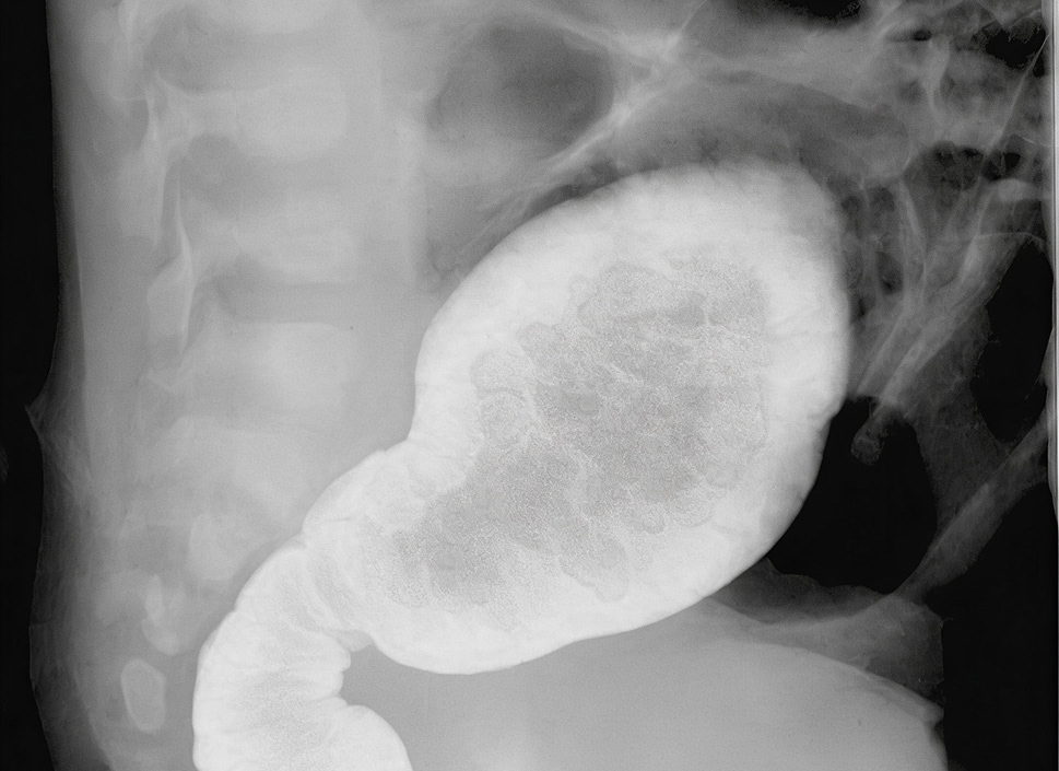 Avances en Rx de Colon por Enema Doble Contraste en Panamá