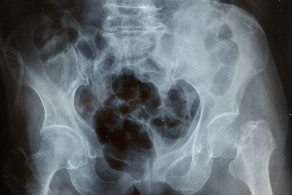 ¿Qué es la histerosalpingografía (HSG) y qué evalúa exactamente